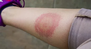 Waspadai Lyme Disease: Penyakit dari Gigitan Kutu yang Bisa Dicegah